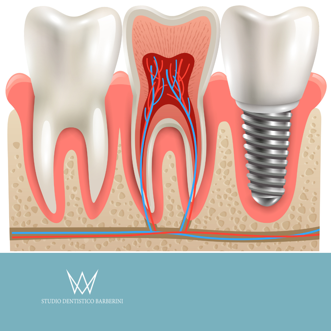 L’impianto sostituisce il dente naturale per un sorriso completo e una masticazione migliore.