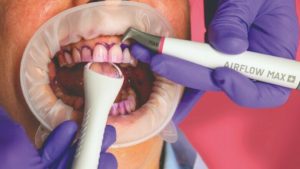 Con la GBT - Guided Biofilm Therapy - l’igienista dentale è guidato dalla sostanza colorante che evidenzia la placca da rimuovere